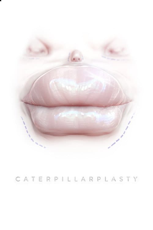 Poster for Caterpillarplasty